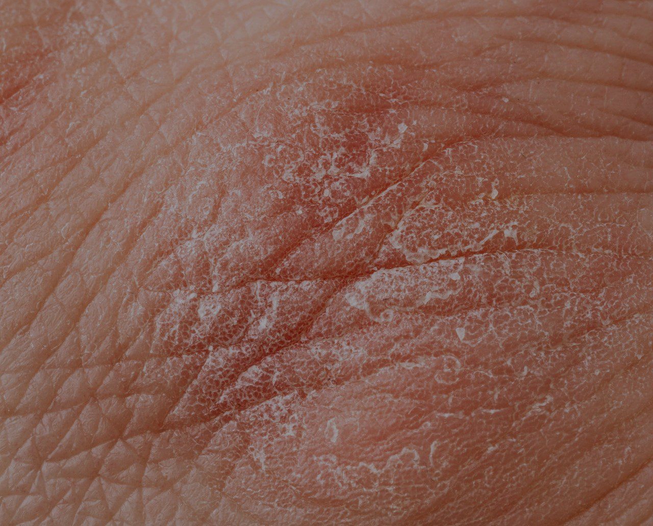 Eczema